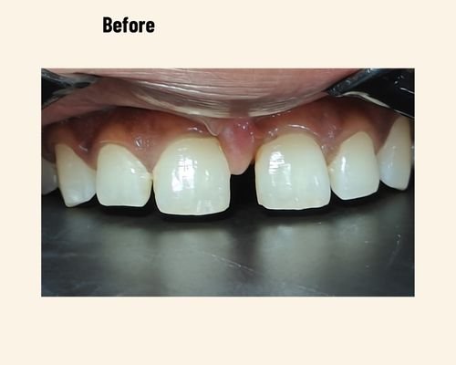 Top Dentist Noida Dr Naina Dental Patient Case Number 11