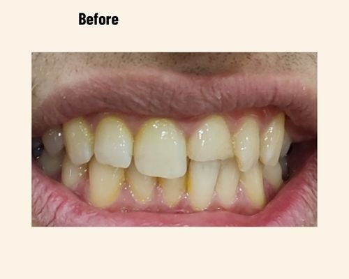 Best Dentist India Dr Naina Dental Patient Case Number 19