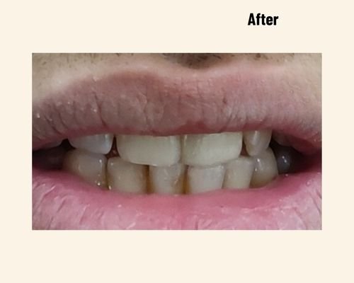 Best Dentist Noida Dr Naina Dental Patient Case Number 20