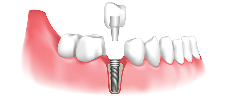 Dental Implants in Noida