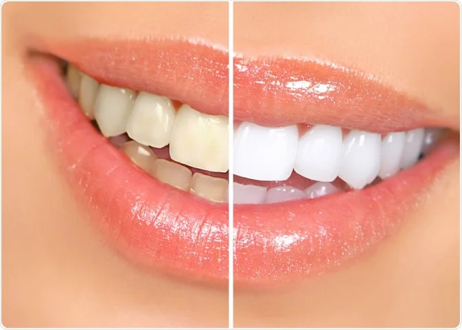 Professional Teeth Whitening in Noida